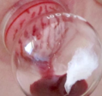 Cupping Therapy Berlin Rangsdorf