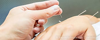 Acupuncture